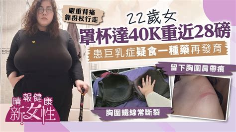 健康新女性︳胸部過大！22歲女罩杯達40k重近28磅 患巨乳症疑食一種藥再發育 嚴重背痛靠拐杖行走 晴報 健康 女性疾病 D220531