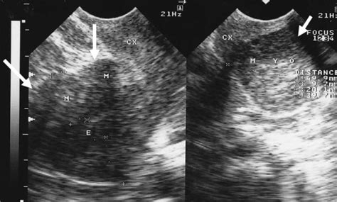 An Intramural Leiomyoma Large Arrows And A Large Cervical Leiomyoma Download Scientific