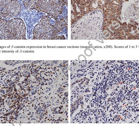 Representative Immunohistochemistry Staining Of Stromal Cd8 And Foxp3