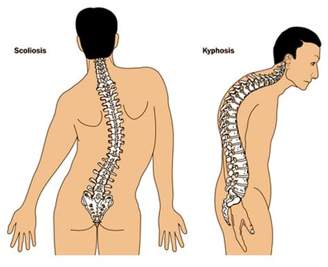 👉 Kyphosis - Types, Symptoms, Causes, Diagnosis, Pictures, Treatment ...