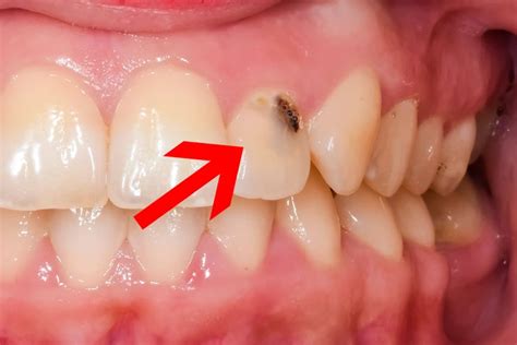 Front Tooth Cavity Causes Symptoms And Treatment