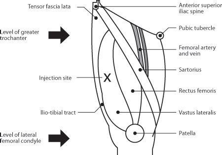 Vastus Lateralis Injection