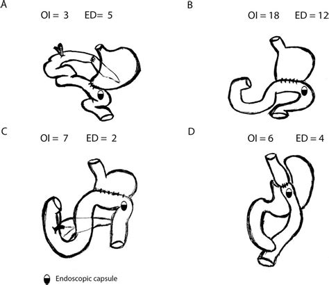 Representation of altered gastrointestinal anatomy due to intestinal... | Download Scientific ...