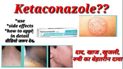 KETOCONAZOLE Cream Lotion Uses Side Effects How To Apply YouTube