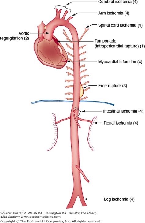 Diseases Of The Aorta Thoracic Key