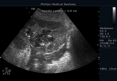 Ultrasonographic Picture Of A Dilated Renal Pelvis Filled With Thick