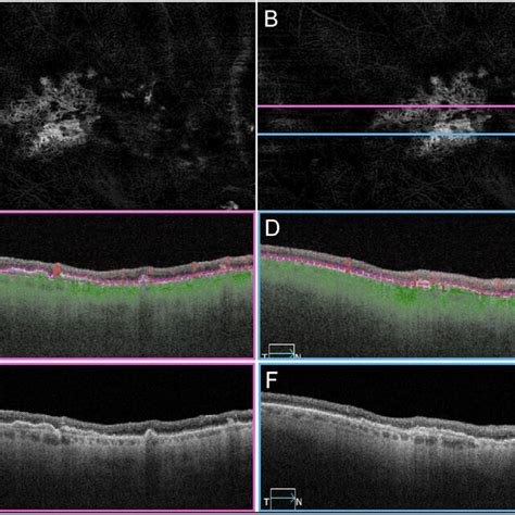 Octa Imaging Of Cnv In Patient Ga Ss Octa En Face And B Scan Imaging