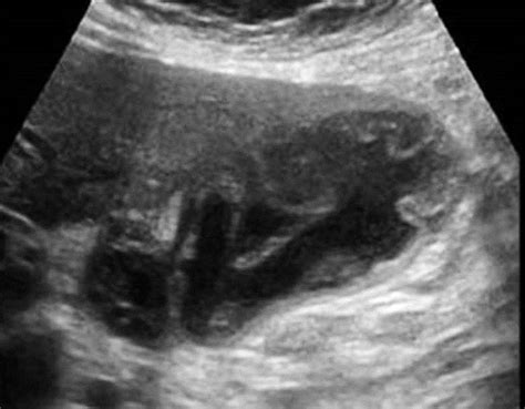 Emphysematous Cholecystitis Ultrasound