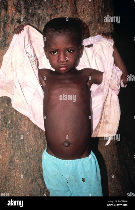 Niño desnutrido Vista de un muchacho enfermo de desnutridos la