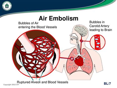 air  trapped   chest  linda gentry blog