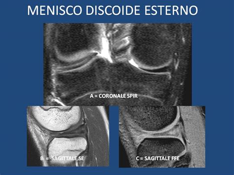 Casistica Di Risonanza Magnetica Nella Patologia Meniscale Radiologia