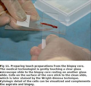 MadTechs Bone Marrow Aspiration