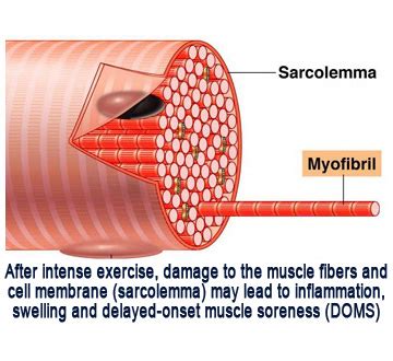 Post Workout Soreness: The Cause & The Cure