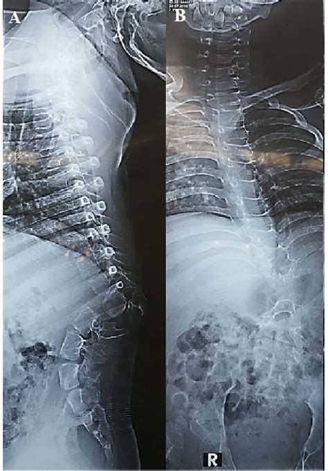 Preoperative. (A) Lateral plain X-ray showing acute kyphosis. (B ...