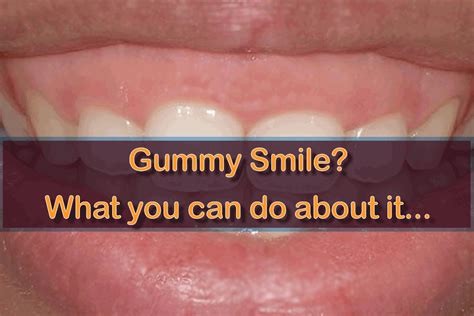 Gummy Smile What You Can Do About It Fine Dental In New York