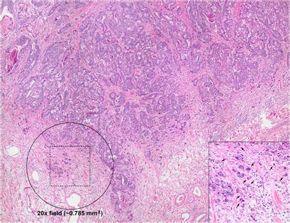 Scoring Of Tumor Budding This Figure Illustrates The Semi Quantitative