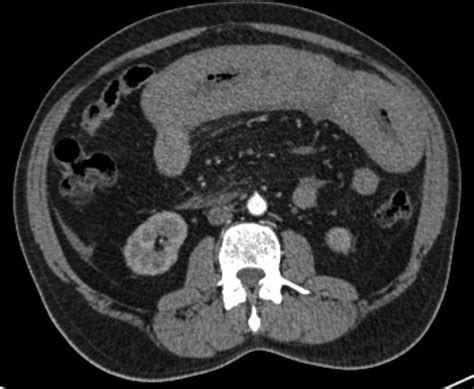 Contrast Enhanced Computed Tomographic Scan Of The Abdomen Showing