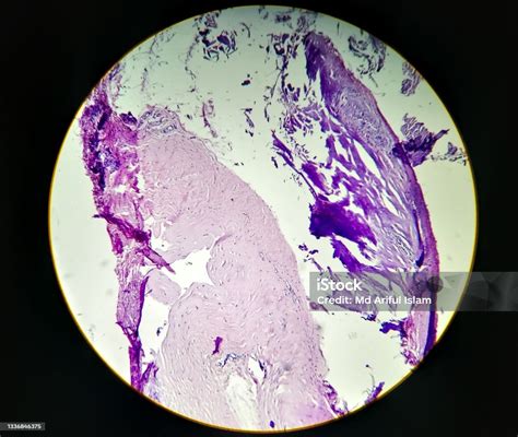 Lobular Capillary Hemangioma Light Micrograph Photo Under Microscope