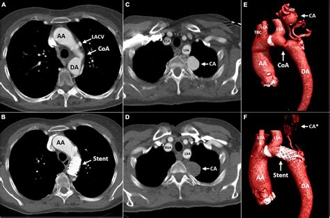 Frontiers A Percutaneous Treatment Strategy Of An Adult Patient With A Bicuspid Aortic Valve