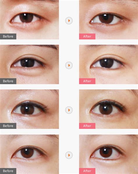 Epicanthoplasty And Lateral Canthoplasty