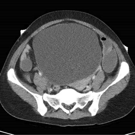 Patients Abdomen Pelvis Computed Tomography CT With Contrast Showing