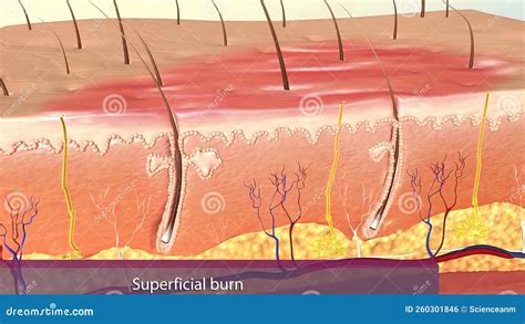 Superfucial Partial Thickness Burn Stock Illustration Illustration Of Dermis Human 260301846