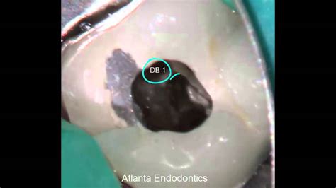 ENT Physician Diagnoses Failed Root Canal YouTube