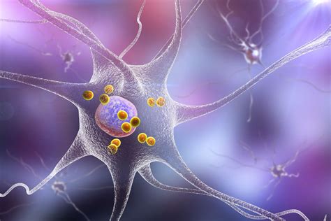 Parkinsons Dementia Vs Dementia With Lewy Bodies