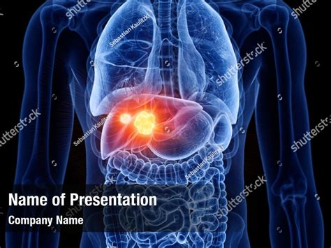 Liver Cirrhosis Ppt Templates Free Power Point Template Ppt Template