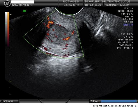 Adenocarcinoma Villoglandular De Cérvix Progresos De Obstetricia Y Ginecología