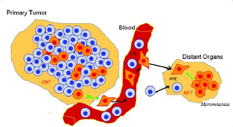 Involvement Of EMT For Metastasis Progression In The Primary Tumor