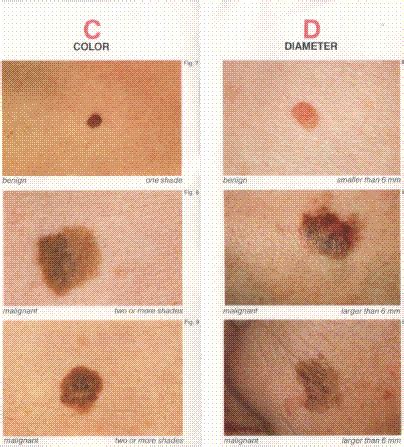 MELANOMA- Diagnosis, Treatment, Prevention, Pictures