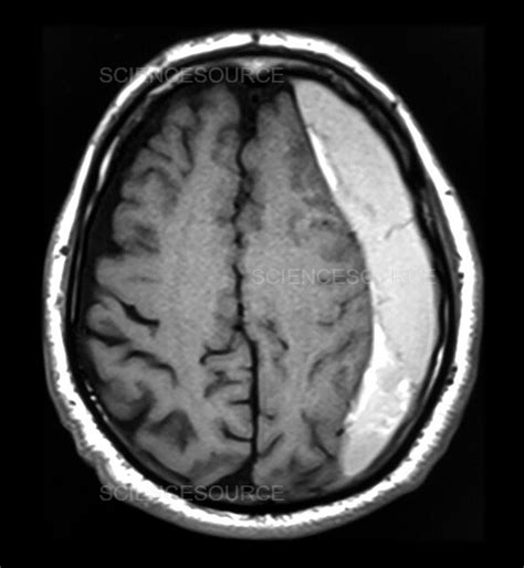 Photograph Mri Subdural Hematoma Science Source Images