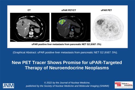 New Pet Tracer Shows Promise For Nens Oncidium Foundation