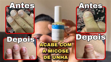 Como Estou Tratando Minha Micose De Unha Ciclopirox