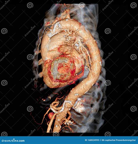 Imagen De Renderización 3D De La Aorta Torácica CTA Para El Aneurisma