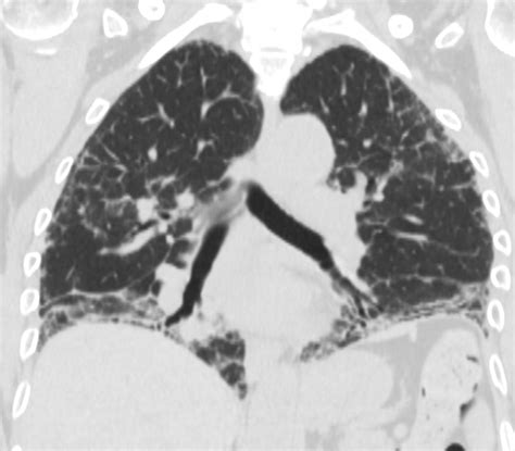 194lu Anti Synthetase Syndrome Nsip Lungs