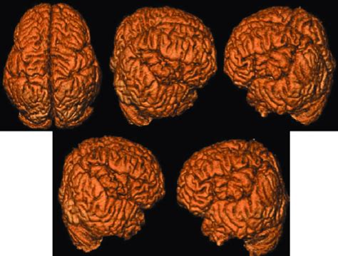 Congenital Bilateral Perisylvian Syndrome The Characteristic 3d