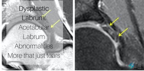 Hip Labrum Tear Mri