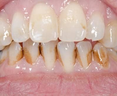 Teeth Discoloration Causes Symptoms Treatment And Prevention