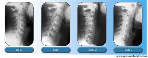 Cervical Spondylosis Zyex Physiotherapy And Rehabilitation Center