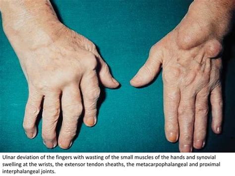 Rheumatoid Arthritis