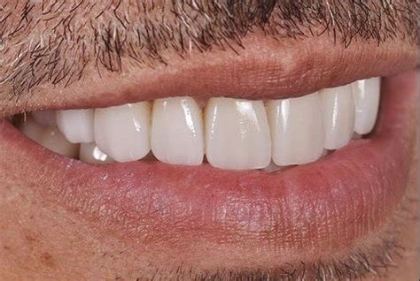 Carillas Sin Tallar Diente Tratamientos Estética Dental En Barcelona