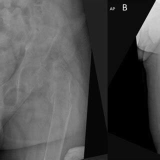 Generalised Osteopenia And Bilateral Femoral Neck Fractures Were Noted