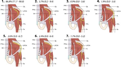 Types Of Exits Of The Lateral Femoral Cutaneous Nerve From The Pelvis