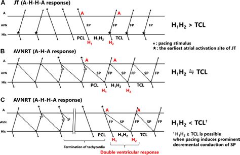 Atrial His Atrial And Atrial His His Atrial Responses During Slow Fast