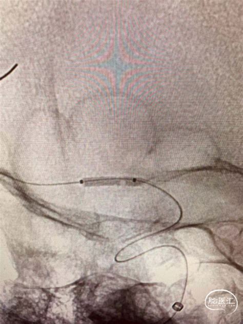 重磅！nova颅内药物球扩支架上海地区植入首秀！ 脑医汇 神外资讯 神介资讯