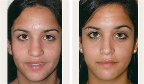 Rhinoplasty NYC - Cost, Recovery, Reviews, Before & After Pics