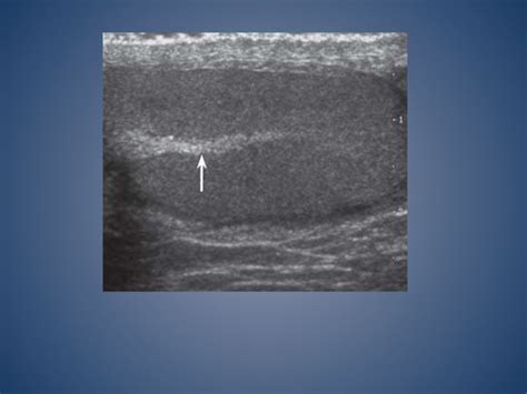 Imaging Of Inguino Scrotal Region PPT