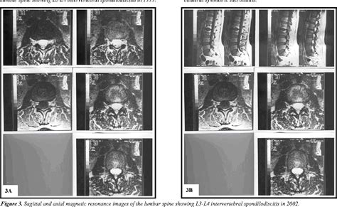 Figure 3 From Spondilodiscitis Due To Ankylosing Spondylitis In A